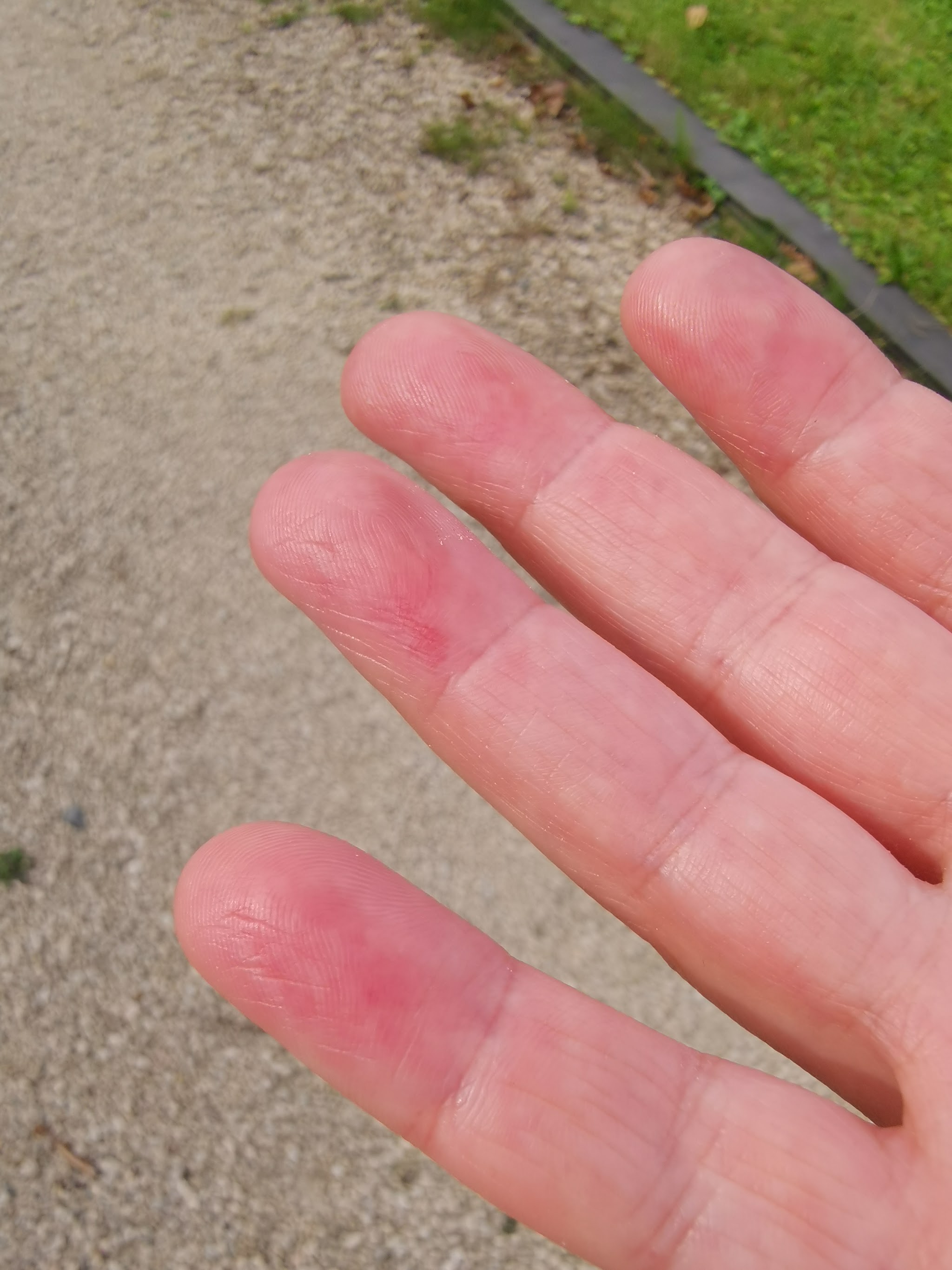 Vier vingertopjes met schaafwonden en afgeschuurde huid na urenlang schuren van de epoxy