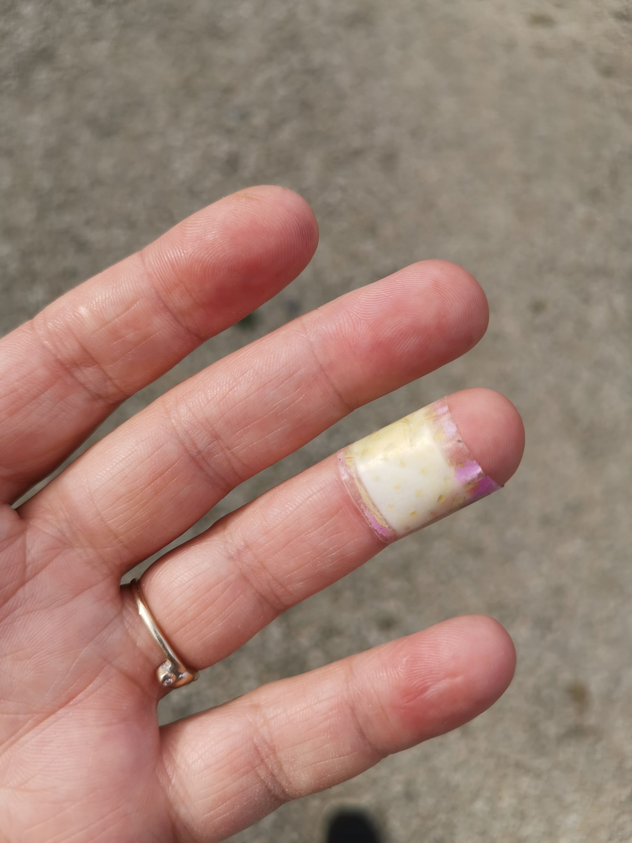 Hand met verbonden middenvinger en donkere verkleuringen na agressief schuren van epoxyhars tot op het bloed